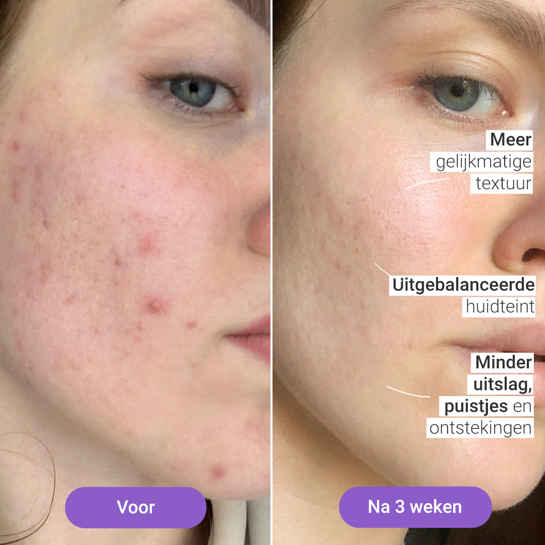 Lichttherapiemasker Lumi